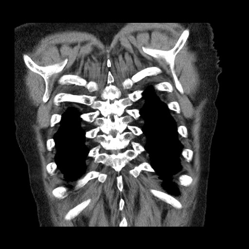 File:Bronchial stenosis - lung transplant (Radiopaedia 73133-83848 Coronal non-contrast 56).jpg