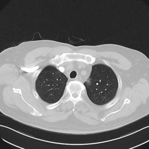 File:Bronchiectasis (Radiopaedia 39385-41666 Axial lung window 15).png