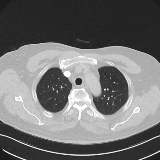 Bronchiectasis (Radiopaedia 39385-41666 Axial lung window 17).png