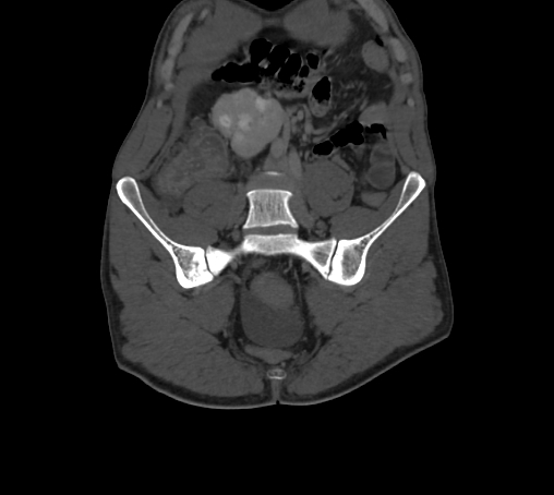 Bronchiectasis in Crohn disease (Radiopaedia 60311-67977 Coronal bone window 11).jpg
