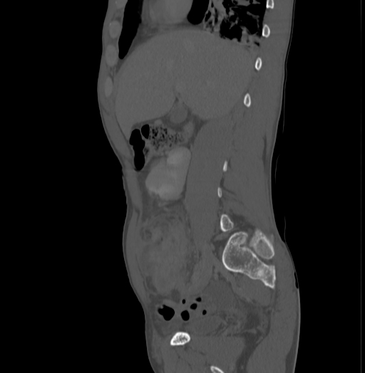File:Bronchiectasis in Crohn disease (Radiopaedia 60311-67977 Sagittal bone window 76).jpg