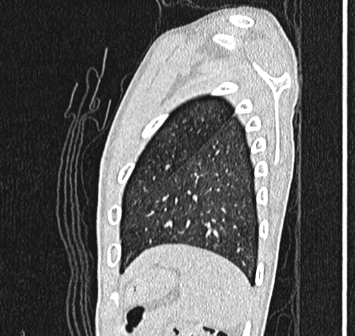 Bronchiolitis obliterans (Radiopaedia 71538-81897 Sagittal lung window 62).jpg