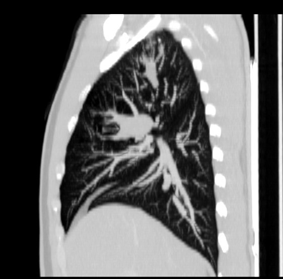 File:Bronchocele (Radiopaedia 12104-12460 Sagittal lung window 5).jpg