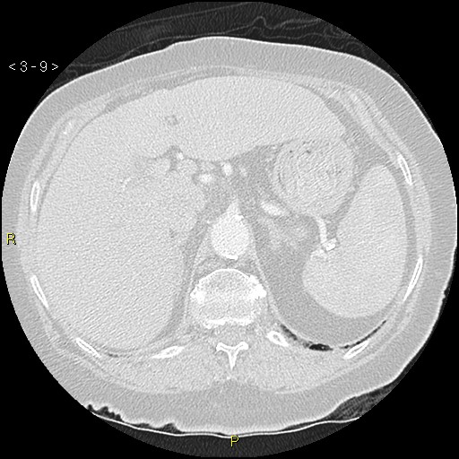 Bronchogenic carcinoma as an incidental finding (Radiopaedia 16453-16130 Axial lung window 9).jpg