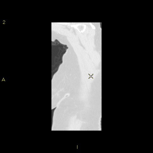File:Bronchogenic carcinoma as an incidental finding (Radiopaedia 16453-16130 Sagittal lung window 3).jpg