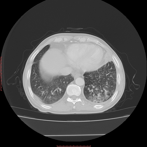 File:Bronchogenic carcinoma with left atrial large deposit - T4N3M1a (Radiopaedia 42316-45428 Axial lung window 23).jpg