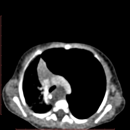 Bronchogenic cyst (Radiopaedia 78599-91409 B 81).jpg