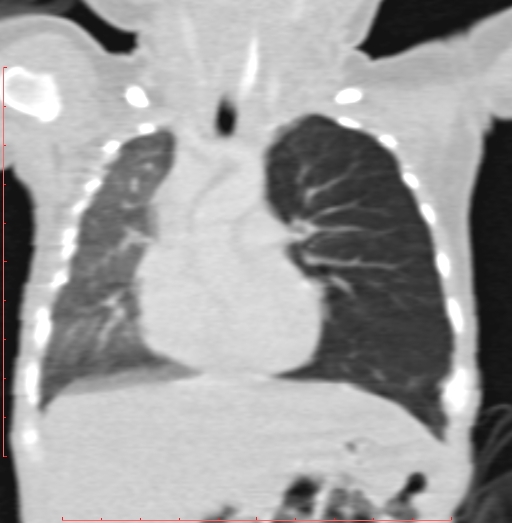 File:Bronchogenic cyst (Radiopaedia 78599-91409 Coronal lung window 104).jpg
