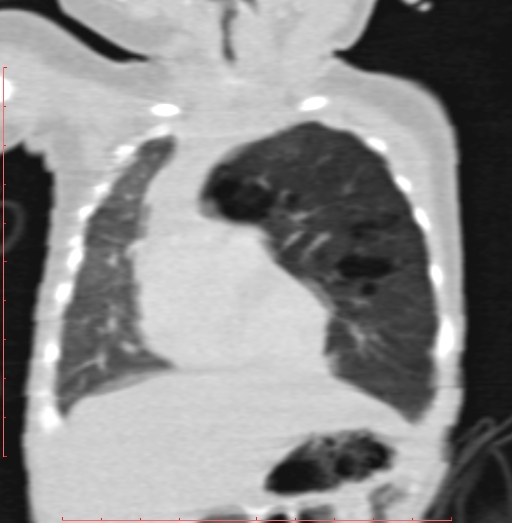 Bronchogenic cyst (Radiopaedia 78599-91409 Coronal lung window 76).jpg