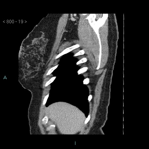 Bronchogenic cyst - posterior mediastinal (Radiopaedia 43885-47364 B 12).jpg
