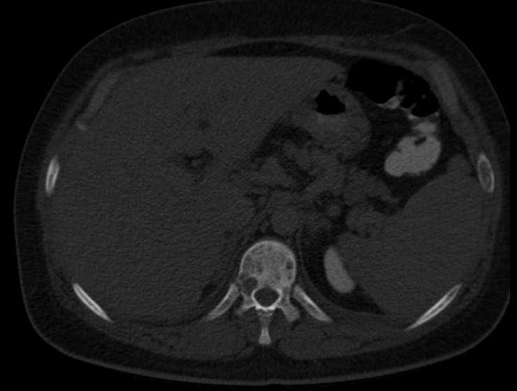 Brown tumors compressing the spinal cord (Radiopaedia 68442-77988 Axial bone window 75).jpg