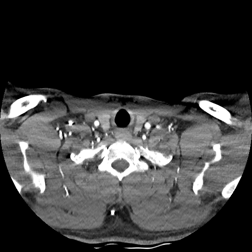 Buccal fat pad arteriovenous malformation (Radiopaedia 70936-81144 D 60).jpg