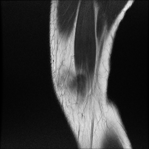 File:Bucket-handle meniscus tear (Radiopaedia 65700-74809 Sagittal T2 2).jpg