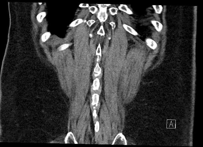 Buried bumper syndrome - gastrostomy tube (Radiopaedia 63843-72577 Coronal Inject 127).jpg