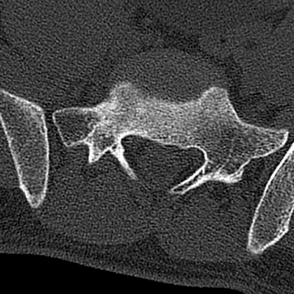 File:Burst fracture (Radiopaedia 53373-59357 Axial bone window 68).jpg