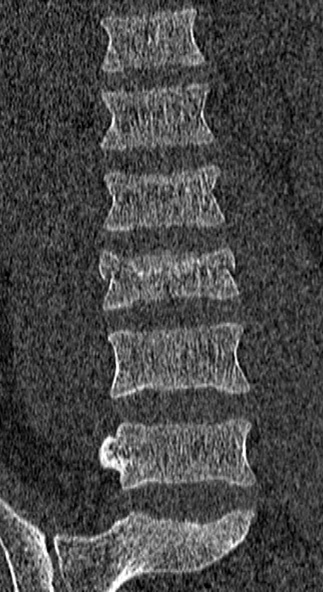 Burst fracture (Radiopaedia 53373-59357 Coronal bone window 26).jpg