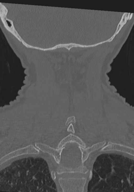 C2 fracture with vertebral artery dissection (Radiopaedia 37378-39199 Coronal bone window 44).png