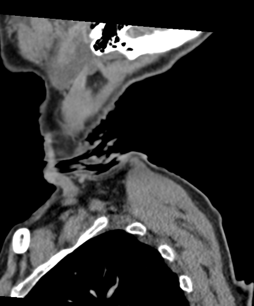 C2 fracture with vertebral artery dissection (Radiopaedia 37378-39199 D 7).png