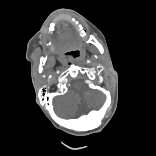 C2 fracture with vertebral artery dissection (Radiopaedia 37378-39200 A 181).png