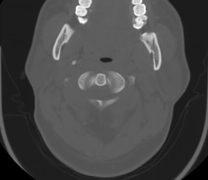 File:C7 laminar fracture and Klippel-Feil syndrome (Radiopaedia 86710-102850 Axial bone window 26).jpg