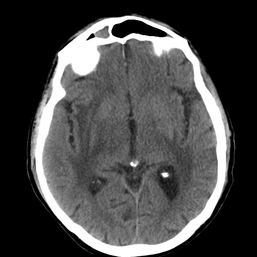 File:CNS lymphoma (Radiopaedia 36983-38639 Axial non-contrast 19).png