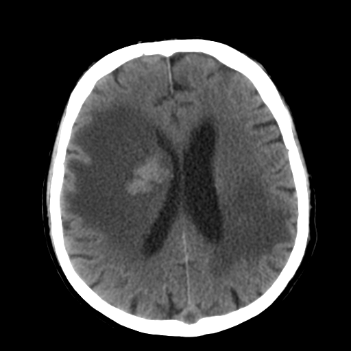 File:CNS lymphoma (Radiopaedia 36983-38639 Axial non-contrast 24).png
