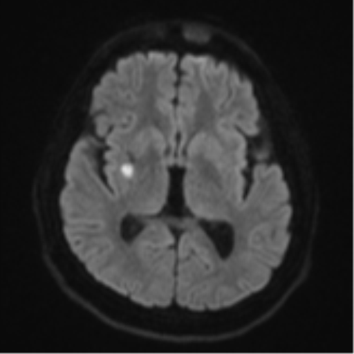 File:CNS vasculitis (Radiopaedia 55715-62263 Axial DWI 44).png
