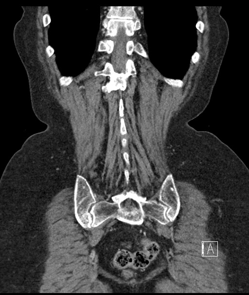 Calcified adrenal glands and Spigelian hernia (Radiopaedia 49741-54988 B 101).jpg