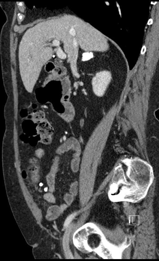 Calcified adrenal glands and Spigelian hernia (Radiopaedia 49741-54988 C 105).jpg