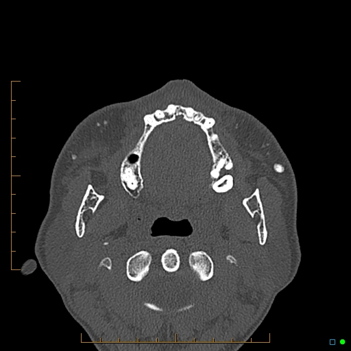 Calcified facial augmentation fillers (Radiopaedia 79514-92679 Axial bone window 81).jpg