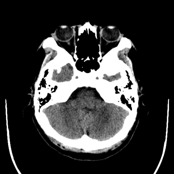 Calvarial osteoma (Radiopaedia 36520-38079 Axial non-contrast 13).jpg