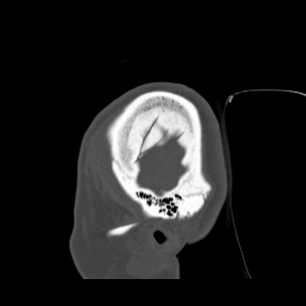 Calvarial osteoma (Radiopaedia 36520-38079 Sagittal bone window 11).jpg