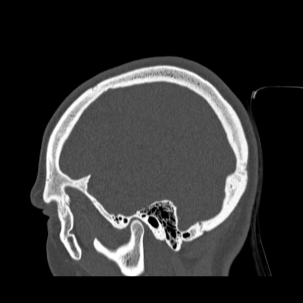 Calvarial osteoma (Radiopaedia 36520-38079 Sagittal bone window 87).jpg