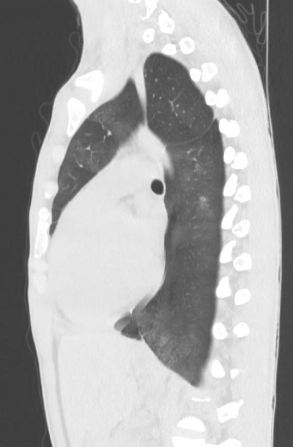 Cannabis-induced diffuse alveolar hemorrhage (Radiopaedia 89834-106946 Sagittal lung window 80).jpg
