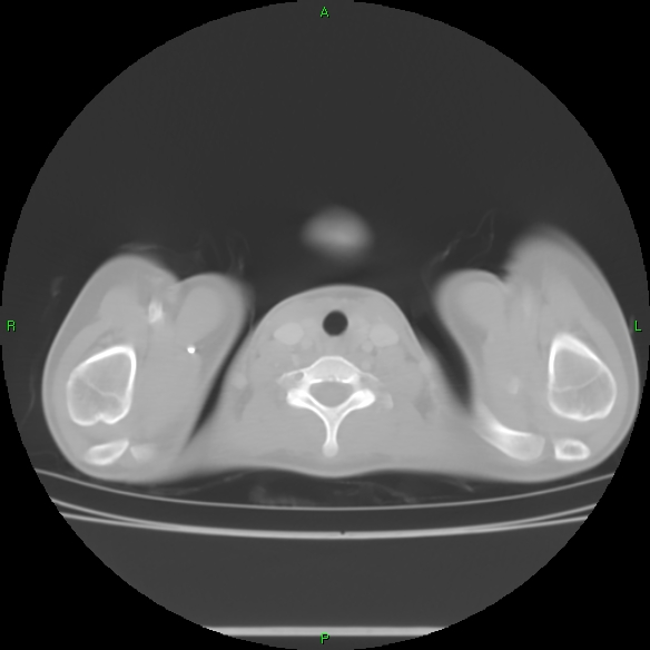 File:Cannon ball metastases - synovial sarcoma (Radiopaedia 26135-26271 Axial lung window 1).jpg