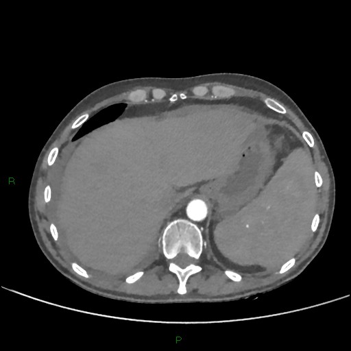 File:Cannonball metastases (Radiopaedia 82110-96150 Axial C+ CTPA 281).jpg