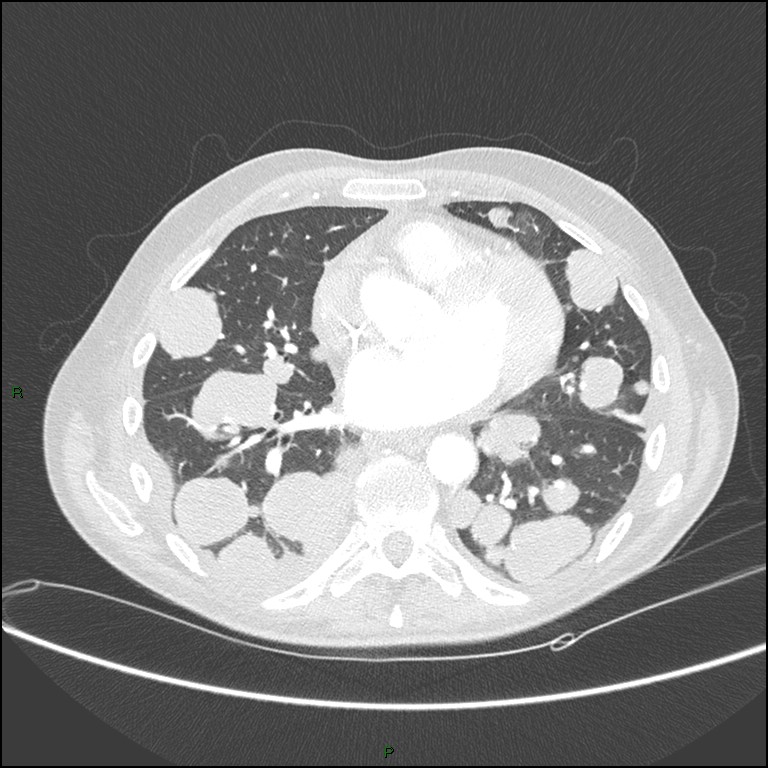Cannonball metastases (Radiopaedia 82110-96150 Axial lung window 120).jpg