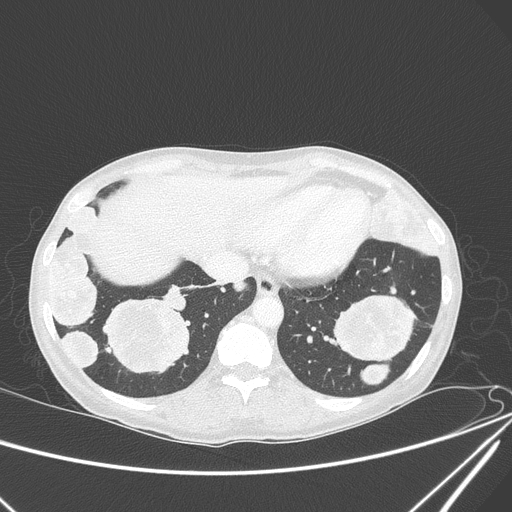 Canonball lung metastasis (Radiopaedia 77634-89837 Axial lung window 142).jpg