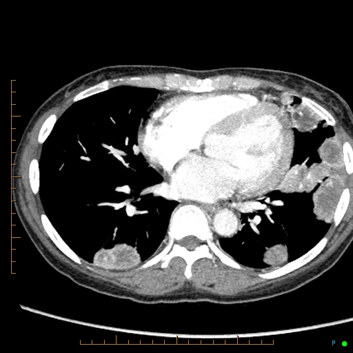 Canonball lung metastasis (Radiopaedia 77634-89837 B 61).jpg