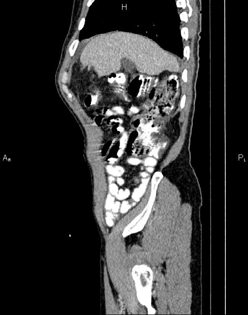 Caput medusae sign - portal hypertension (Radiopaedia 64007-72759 B 7).jpg