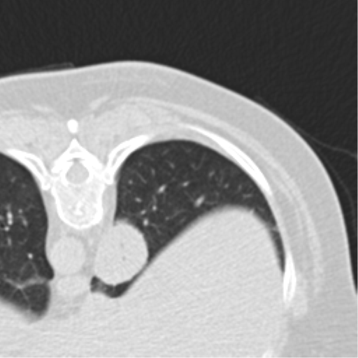 File:Carcinoid tumor - lung (Radiopaedia 44814-48644 Axial lung window 73).png