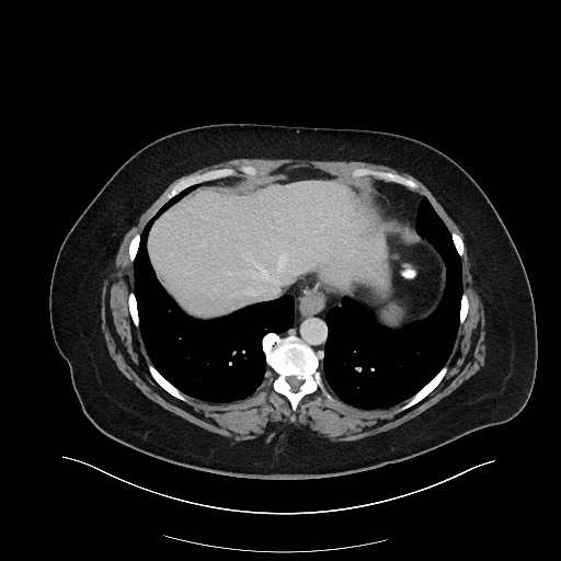 File:Carcinoid tumor - terminal ileum (Radiopaedia 60931-68739 Axial 107).jpg