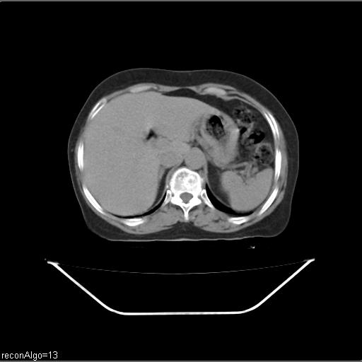 Carcinoma cervix- recurrence (Radiopaedia 34702-36137 B 63).jpg