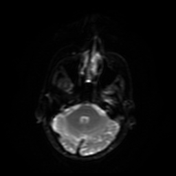 Carcinoma ex-pleomorphic adenoma of parotid (Radiopaedia 28383-28627 Ax DWI B-500 GE 26).jpg