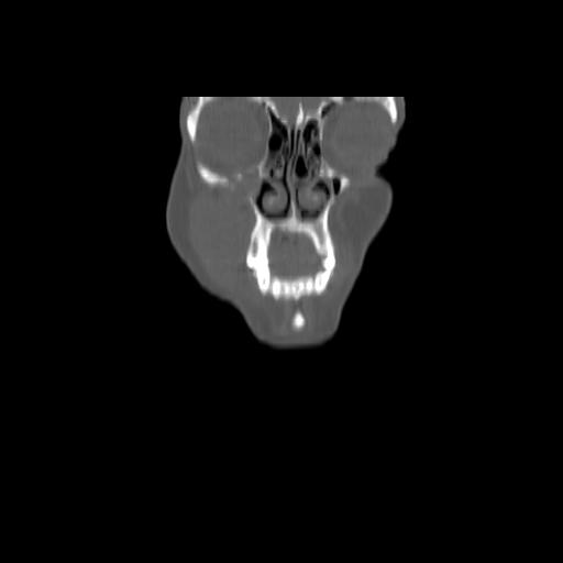 Carcinoma of the maxillary antrum (Radiopaedia 53805-59888 Coronal bone window 23).jpg