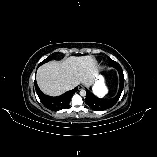 Carcinoma of uterine cervix (Radiopaedia 85861-101700 A 29).jpg