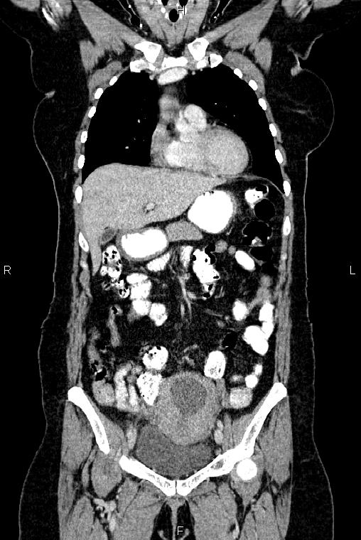 Carcinoma of uterine cervix (Radiopaedia 85861-101700 C 17).jpg
