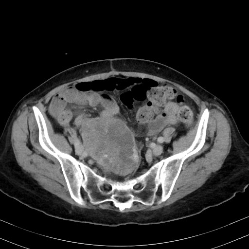 Carcinosarcoma (Radiopaedia 70401-80503 A 50).jpg