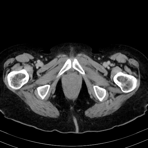 Carcinosarcoma (Radiopaedia 70401-80503 A 72).jpg