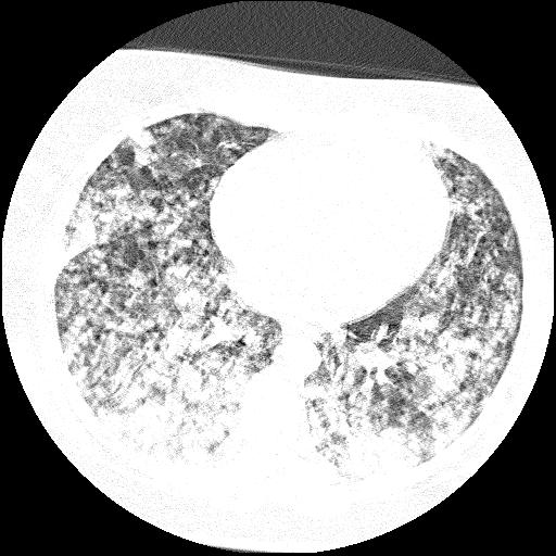 Cardiac angiosarcoma (Radiopaedia 66010-75181 Axial lung window 33).jpg